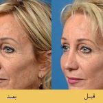 EMk3MB1rKsXmAMCjGDB8ZMKHccTbG48t23fThmykEeBwjB1Hw3SkHdFNMNyaFeZWe- لیفتینگ (لیفت) صورت یا کشیدن پوست صورت برای جوانسازی