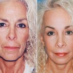 facelift brow laser 2- لیفتینگ (لیفت) صورت یا کشیدن پوست صورت برای جوانسازی