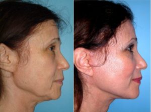 قبل و بعد2- لیفت و کشیدن پوست صورت با نخ