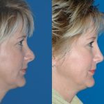 4 2- عمل جراحی ترمیمی بینی (ثانویه)