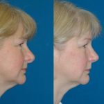 5 2- عمل جراحی ترمیمی بینی (ثانویه)