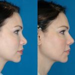 6 2- عمل جراحی ترمیمی بینی (ثانویه)