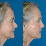 7 1- عمل جراحی ترمیمی بینی (ثانویه)