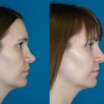 8 1- عمل جراحی ترمیمی بینی (ثانویه)