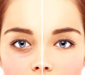 جراحی پلک چیست؟
