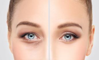eyelid surgery- عمل زیبایی بلفاروپلاستی یا جراحی پلک چیست؟