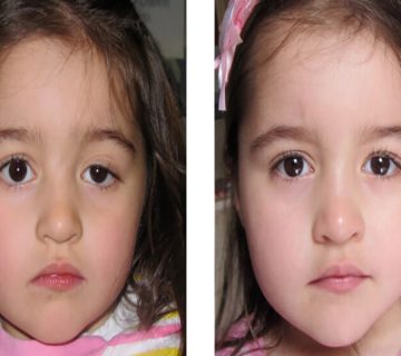 افتادگی پلک در کودکان