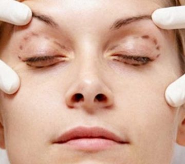 جراحی زیبایی پلک(بلفاروپلاستی) 4 Blepharoplasty01 1- جراحی زیبایی پلک(بلفاروپلاستی)