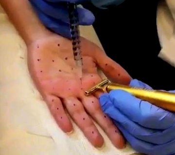 تزریق بوتاکس کف دست و مزایای آن 6 Botox injection of palms04 1- تزریق بوتاکس کف دست و مزایای آن