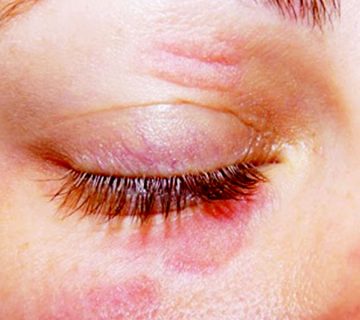 درماتیت پلک چیست؟ 3 Dermatitis of the skin- درماتیت پلک چیست؟