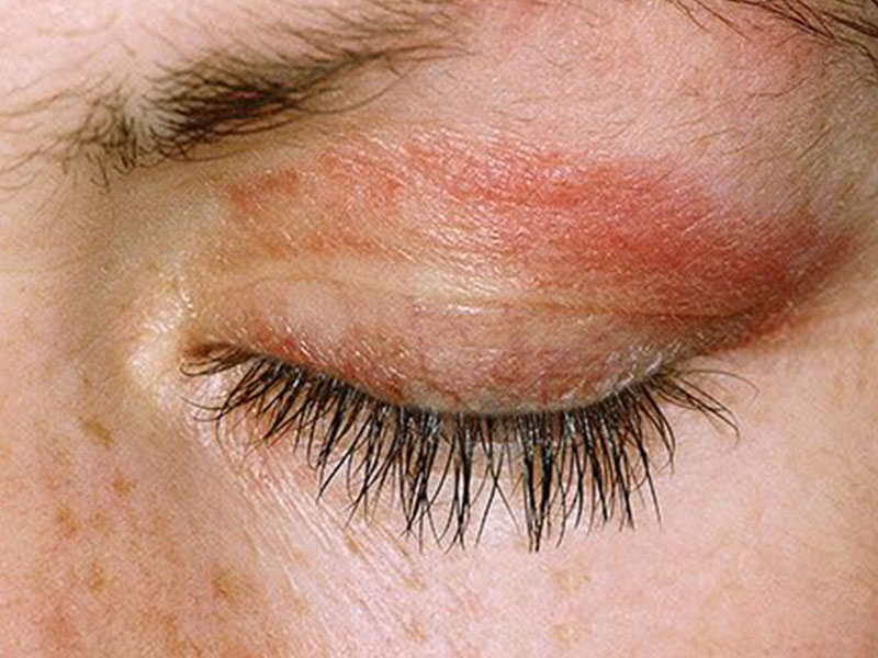 Dermatitis of the skin02- درماتیت پلک چیست؟