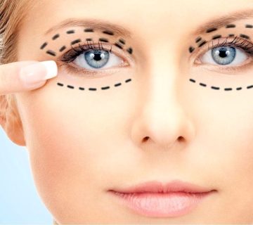 Blepharoplasty 001- عمل زیبایی بلفاروپلاستی یا جراحی پلک چیست؟