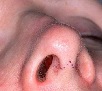 درباره بخیه های جراحی بینی بیشتر بدانید 4 بخیه های جراحی بینی